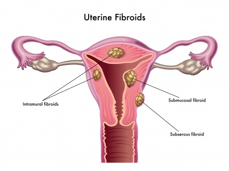 Endometrial cancer or fibroids